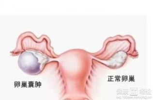 卵巢囊肿是怎样产生的