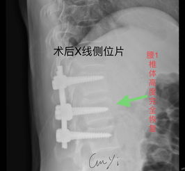 腰椎骨折早期手术干预,可达到很好的恢复效果