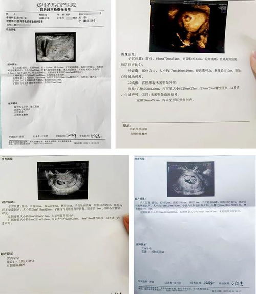 移植后HCG低医生不建议保胎,患者想保胎那我们就努力一把