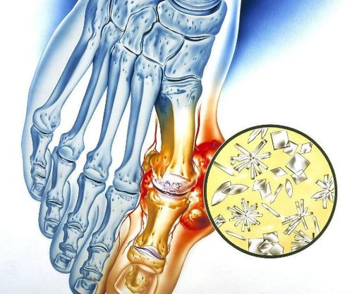尿酸高650，痛风该如何缓解(尿酸600高到什么程度了,痛风能引起痛)