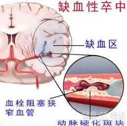 陈旧性脑梗塞会不会有后遗症