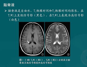 磁共振水成像在脊柱疾病的临床应用研究