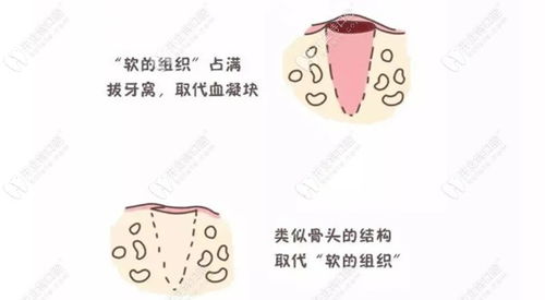 拔牙后留下的牙洞多久可以愈合,吃啥食物有利于尽快恢复