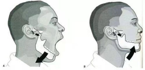 核酸采样导致下巴脱臼 专家远程指导复位,同时提醒 检测时避免快速大张口