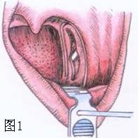 耳鼻咽喉头颈外科手术征集 茎突过长切除术