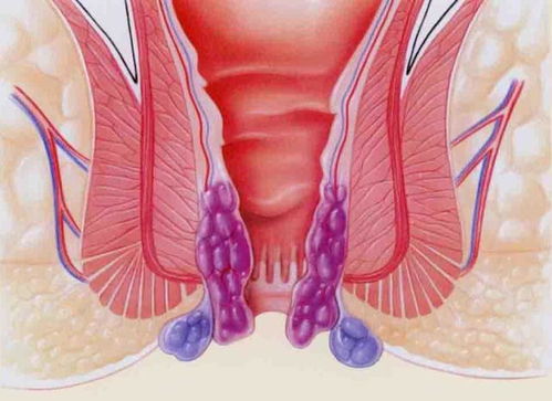 常见红霉素软膏竟有这功效 简单几步轻松治痔疮,患者极力推荐