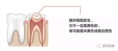 补牙价格差异为何这么大 不花冤枉钱 揭秘你不知道的补牙秘密