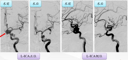 第十五期丨高国栋教授 左侧颈内动脉眼段动脉瘤夹闭术 