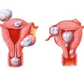 子宫肌瘤百科 子宫肌瘤医学疾病文章列表,第55页 快速问医生 