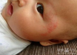 婴儿湿疹偏方，婴儿湿疹的小偏方