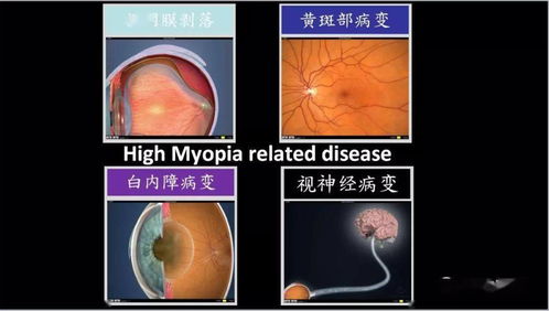 我有个同学高度近视,医生为什么不让他献血