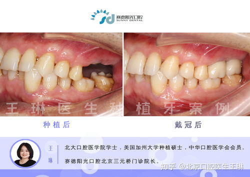 种好的牙牙冠可以更换吗 