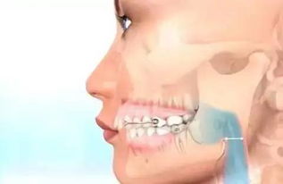牙齿矫正究竟是怎么改变我们的脸型的 