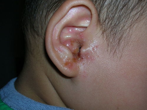 外耳湿疹(外耳湿疹有哪些表现)