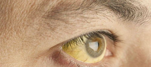 眼球总是发黄,有红血丝是怎么回事