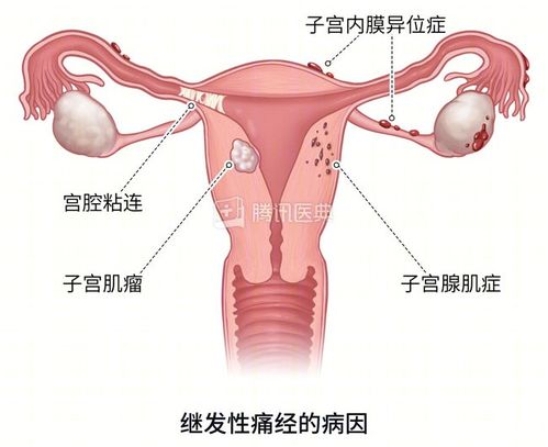 以前不痛经的人,突然开始痛经,要注意这个病