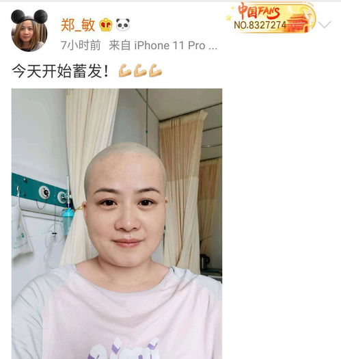 岳云鹏妻子患病剃光头做手术,未见老公陪伴显孤单