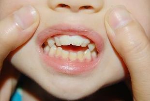 孩子牙齿不整齐的危害 