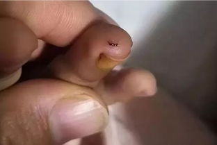 合肥一4岁男童在幼儿园被老鼠咬伤手指 官方通报来了