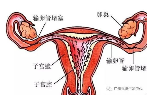 输卵管通水检查时，能否得知输卵管是否阻塞(查输卵管通水疼吗)