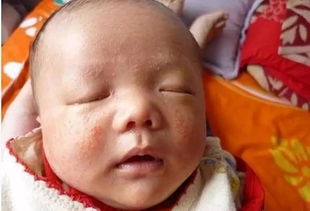 克洛松婴儿湿疹,婴儿湿疹能用艾洛松糠酸莫米松乳膏