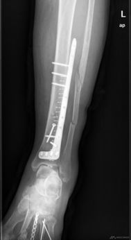 左小腿胫腓骨骨折图片 图片搜索