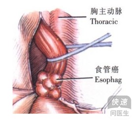 食道癌吃什么药 介绍提高治愈率的几种方法