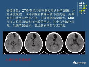 颅脑先天性疾病影像诊断