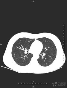 肺部小结节身体有什么症状,肺结节病有哪些症状？