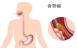 食道炎与食道癌仅有一字只差,两者之间有什么区别 