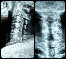 病例 颈椎椎管狭窄症一例 