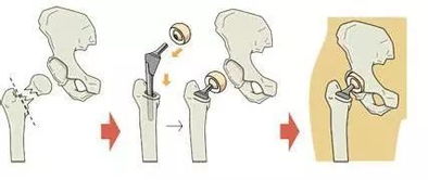 髋关节置换风险大吗(髋关节置换的成功率高吗)