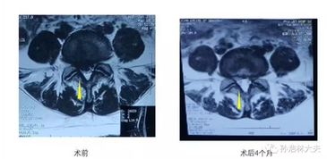 常见问答 十 腰椎间盘突出症微创手术后多久能正常运动 ...