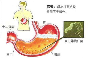 幽门螺杆菌会致癌 为什么不杀之而后快 防病保健