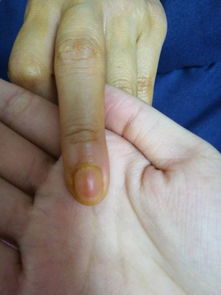 求医38岁女,左手中指莫名肿大,中指右侧指甲右侧缝隙处尤其肿疼,整个中指第一个关节以上都疼,且肿大 