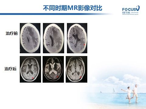 基因检测没有突变,可以用靶向药吗