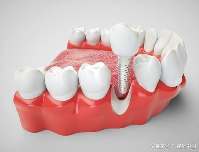 详解种植牙全过程,看完都懂了