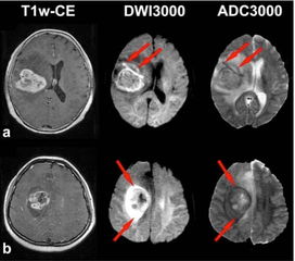 研究进展 脑胶质瘤MRI浸润征象与预后 浙二神外周刊 第143期 
