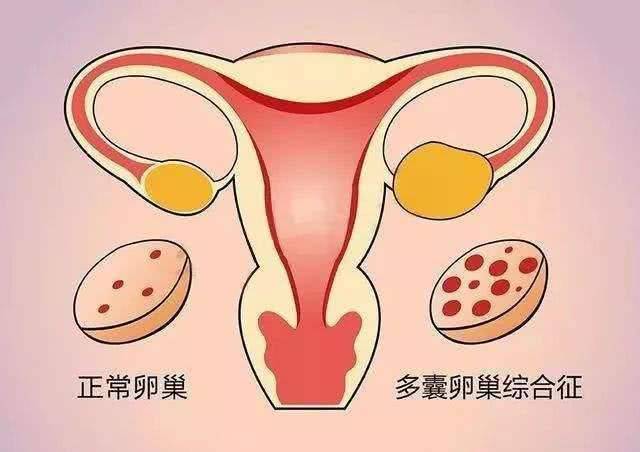 小多囊,大学问 得了多囊卵巢到底该怎么办 女性 生育 治疗 