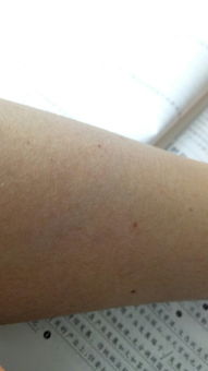 为什么我手臂上会有红色的点 这是什么 