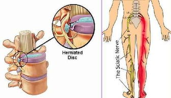 腰间盘突出的症状自测 外伤性腰椎间盘突出是原有疾病，法医是怎么做伤情鉴定的？ 