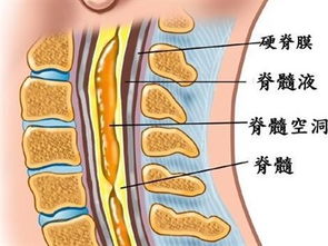 脊髓空洞症做完手术多久恢复原状 