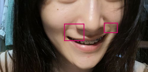 为什么笑起来鼻子两边会有这种纹路 不是法令纹 