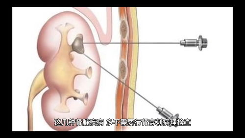 这几种肾病不用做肾穿刺,你做了吗 