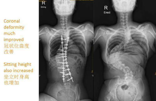 27岁女孩脊柱侧弯150度获救治 听听骨科大咖周六开讲怎么说