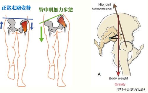 不明原因腰痛,可能是骶髂关节失能