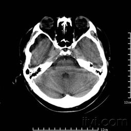 头部病变 医学影像学讨论版 爱爱医医学论坛 