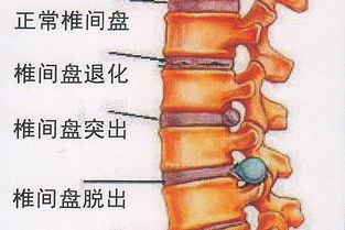 腰椎间盘突出症状讲解 古方源知识课堂