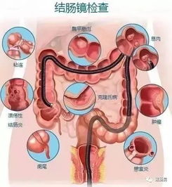 胶囊肠镜看的全面吗，和传统的肠镜比如何