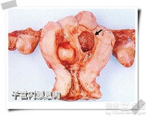 当子宫息肉>2cm时影响试管移植吗？